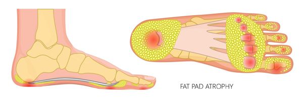 Fat Pad Atrophy of the Foot - The Center for Mortons Neuroma